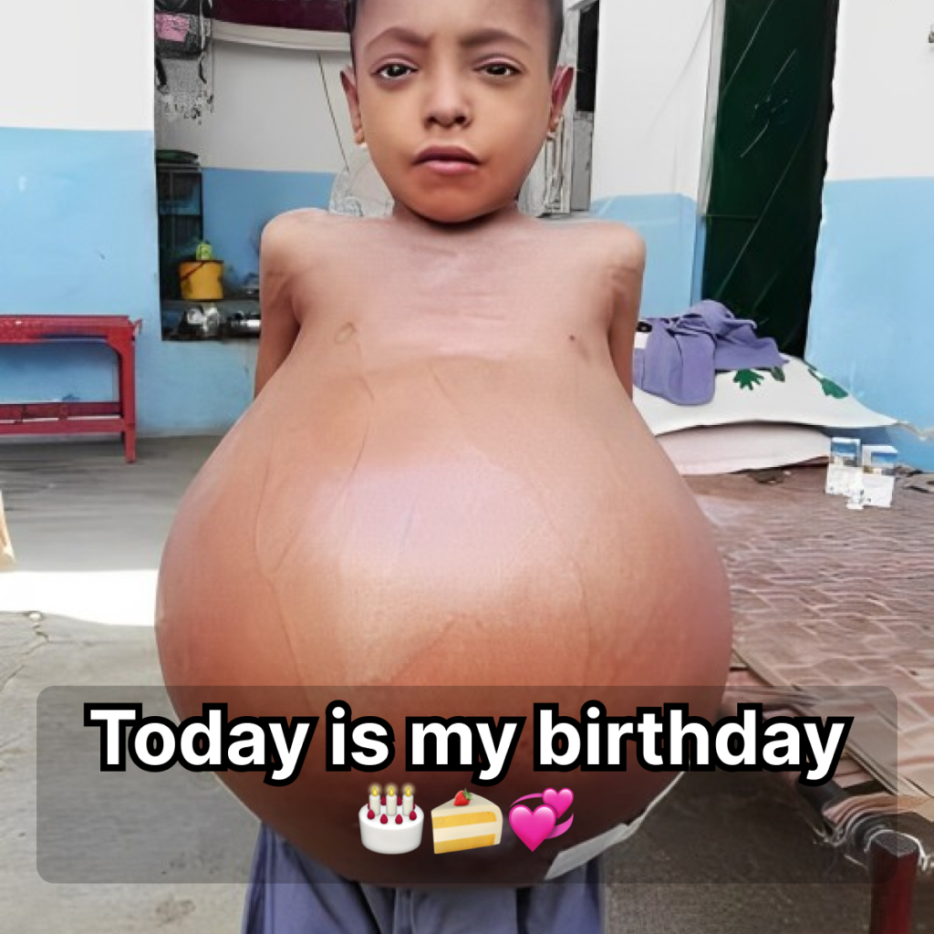 The boy’s stomach was very swollen, but his family could not afford to pay a large amount of money for transplant surgery at the hospital.dubi